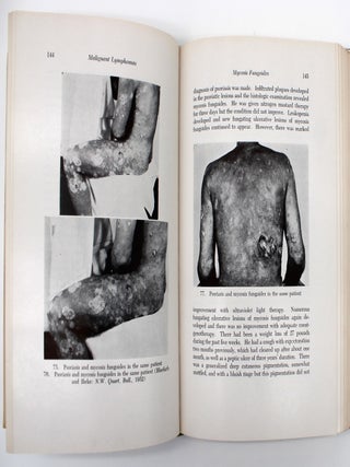 Cutaneous Manifestations of the Malignant Lymphomas