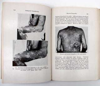 Cutaneous Manifestations of the Malignant Lymphomas