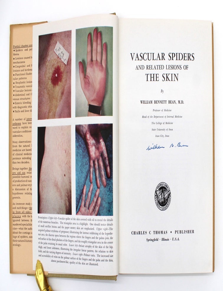 Item #1018 Vascular Spiders and Related Lesions of the Skin. William Bennett Bean.