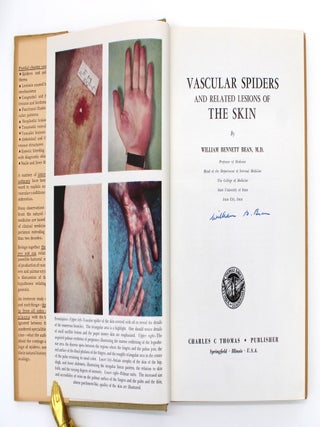 Item #1018 Vascular Spiders and Related Lesions of the Skin. William Bennett Bean