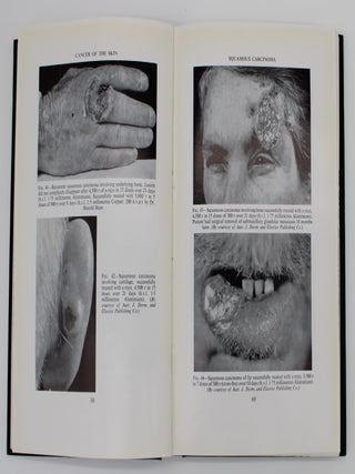 Cancer of the Skin