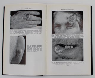 Cancer of the Skin