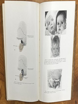 The Operative Treatment of Facial Palsy