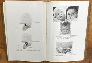 The Operative Treatment of Facial Palsy