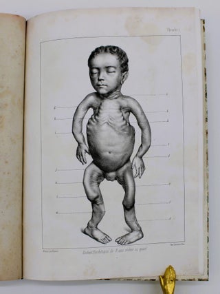 Du Rachitis, de la Fragilit&eacute; des Os, de l&rsquo;Ost&eacute;omalacie