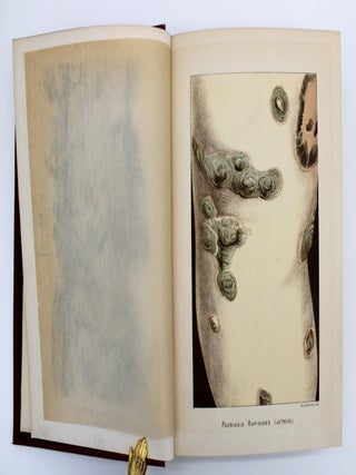 A Treatise on Diseases of the Skin with Special Reference to Their Diagnosis and Treatment, Including an Analysis of 11,000 Consecutive Cases